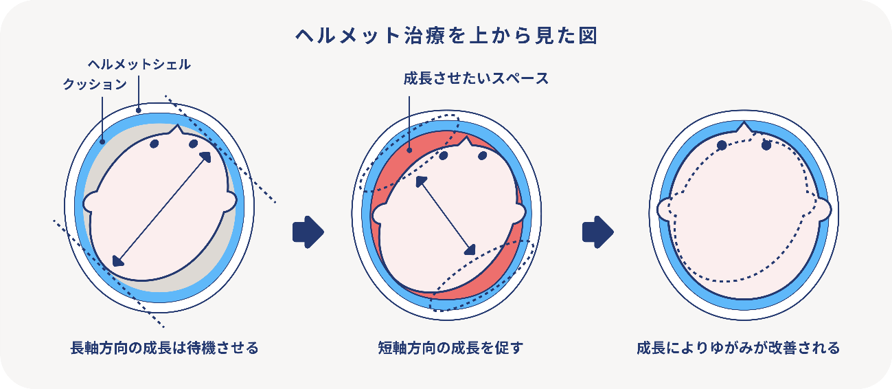 赤ちゃんの頭の形外来