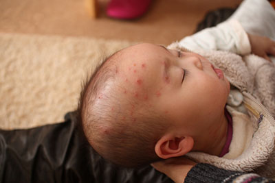 水ぼうそうとは